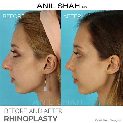 The Main Goals For This Lovely Patient Were To Have A Straighter Nose