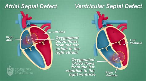 Septal Defect Hole In The Heart Closures St Vincent S Heart Health