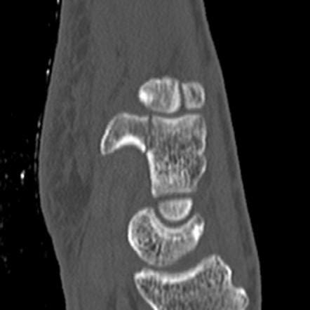 hamate fracture ct hook carpal radiopaedia fractures seen orthopaedicsone fx