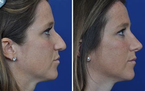 Rhinoplasty Before And After Photos Annapolis Md Nose Job