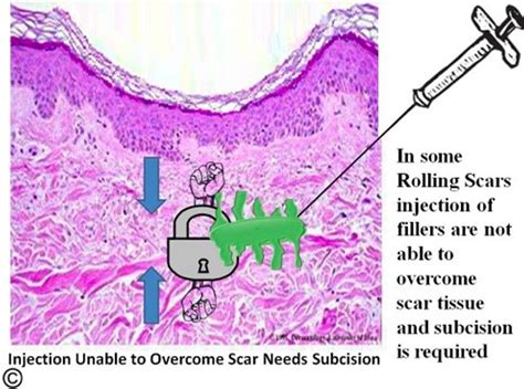 Rolling Atrophic Scars Gainesville Fl Acne Scars Treatment Florida