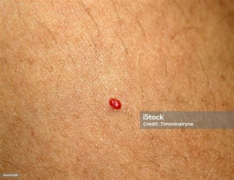 Angioma Red Mole On The Body Birthmark On Skin Stock Photo Download