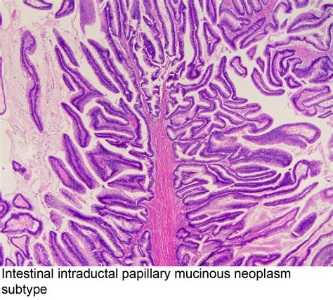 Pathology Outlines Intraductal Papillary Mucinous Neoplasm