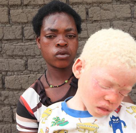Albinos Welle Von Morden Im Afrikanischen Staat Malawi Welt