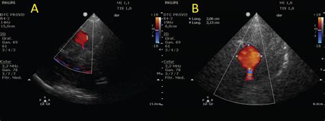 Transcranial Color Coded Duplex Ultrasonography In The Diagnosis Of