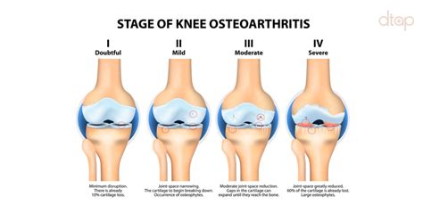 Osteoarthritis Knee Oa Mens Health Clinic In Singapore