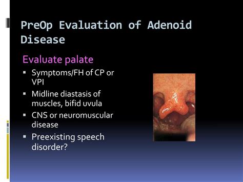 Ppt Tonsillectomy And Adenoidectomy Powerpoint Presentation Free