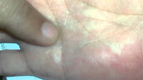 Skin Cancer Bumps On Hand