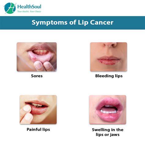 Lip Cancer Symptoms Cancerwalls