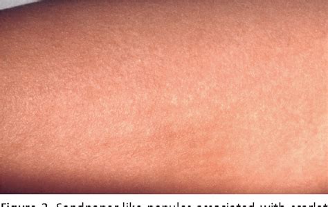 Pdf Common Skin Rashes In Children Semantic Scholar