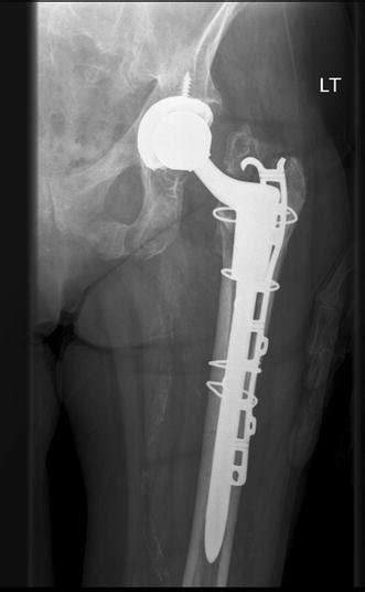 Cableplate Fixation Of Periprosthetic Fracture Download Scientific