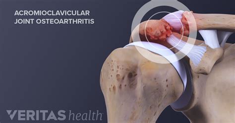 What Is Acromioclavicular Arthritis Ac Joint Arthritis