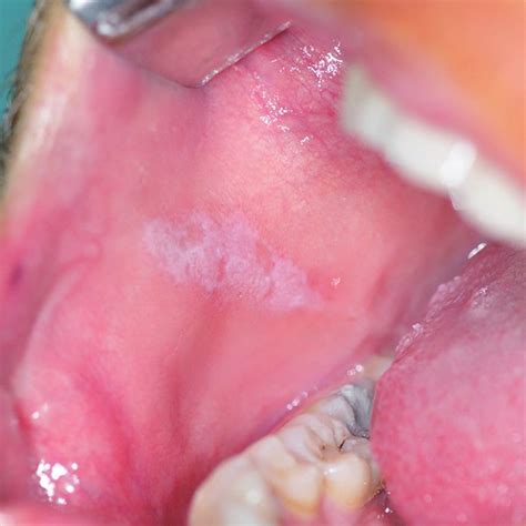 Ol Lesion Of The Right Buccal Mucosa Before Treatment Download