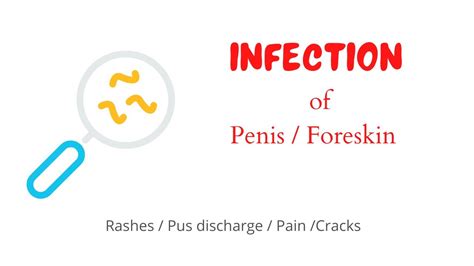 Infection Of Penis And Foreskin Youtube