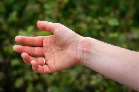 Dermatitis Or Eczema On Human Hand Close Up Of Skin Condition