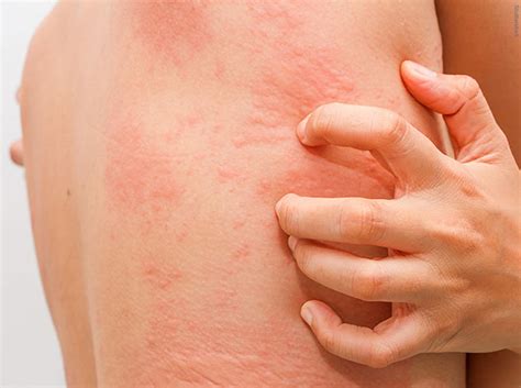 Urticaria Causes Symptoms Treatment Home Remedies