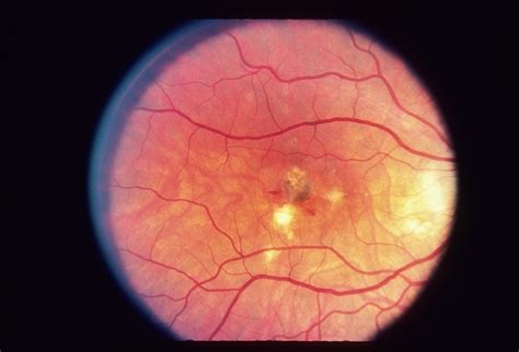 Intraretinal Hemorrhages Case 2 Retina Image Bank