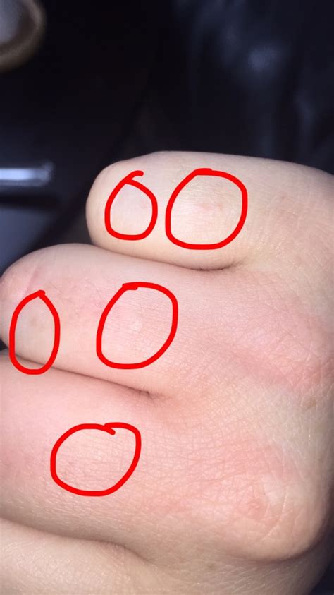 Small Itchy Bumps On Hands And Feet Causes Treatments