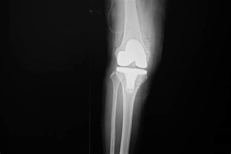 Abnormal Knee X Ray Pics Stock Photos Pictures And Royalty Free Images