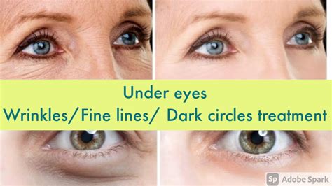 Under Eye Fine Lines Wrinkles Dark Circles Treatment 100 Results