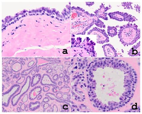 Unusual Anogenital Apocrine Tumor Resembling Mammary Like Gland Adenoma In Male Perineum A Case