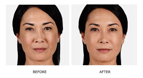 JuvÉderm® Before And After Photos Renew Medspa