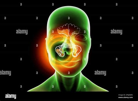 Inflamed Sinuses Hi Res Stock Photography And Images Alamy