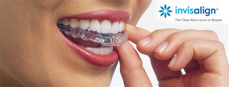 Everything You Need To Know About Invisalign How It Works How Much