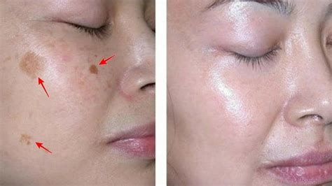 ازالة البقع من الوجه 10 علاجات مضمونة لإزالة بقع الوجه ما هي بقع