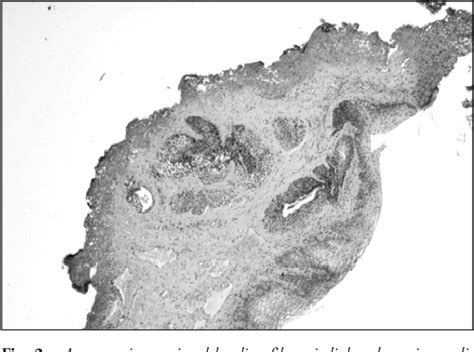 Figure 2 From A Rare Case Of Fibroepithelial Polyp Of The Proximal