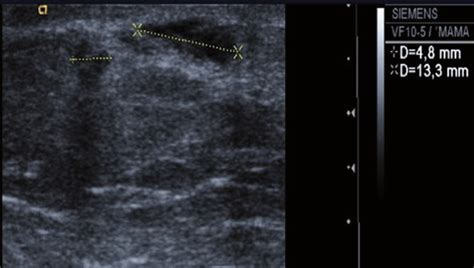 Ultrasound Examination With Two Nonspecific Hypoechoic Masses