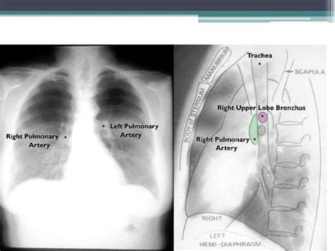 Chest X Ray Positioning