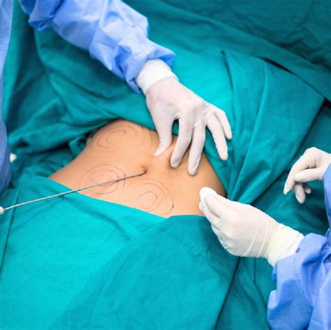 Liposuction Vs Non Surgical Fat Reduction In Singapore