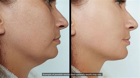 Double Chin Removal The One Hour Chin Lift Alc