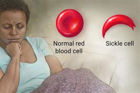 State Dropping 15 M On Sickle Cell Care Helps Blacks Others Living