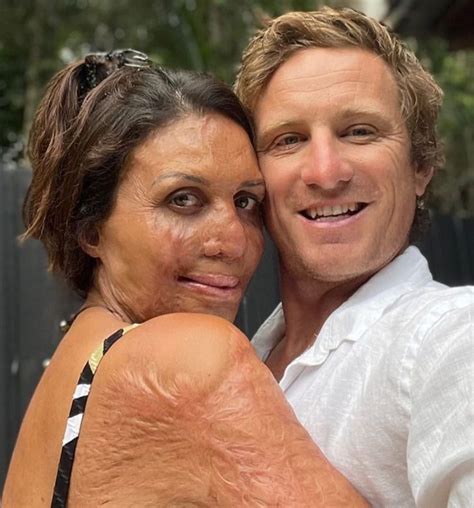 The Unbelievable Story Of Turia Pitt And Her Husband Whose Love Helped Her To Survive A Deadly