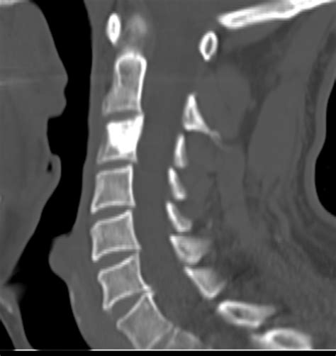 Osteoblastoma Cervical Spine Image
