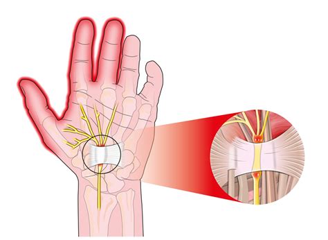 How Do I Get Instant Relief From Carpal Tunnel Advanced Chiropractic Spine And Sports Medicine