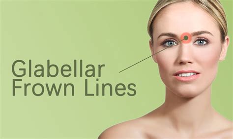 Glabellar Frown Lines Botox Treatment In Surat Gujarat India