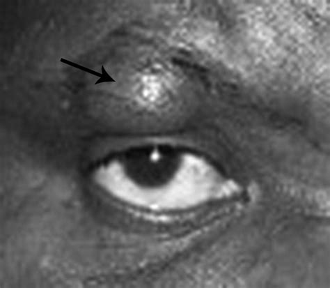 Proliferating Trichilemmal Cyst Of The Eyelid American Journal Of