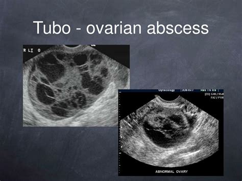 Tubo Ovarian Abscess On Ultrasound