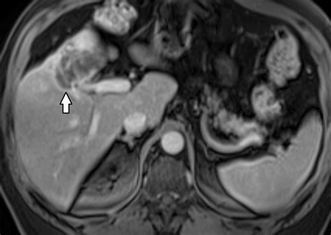 Gallbladder Carcinoma And Its Differential Diagnosis At Mri What