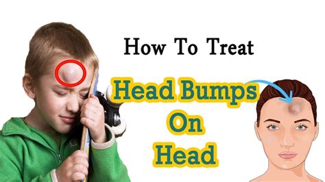 How To Get Rid Of Head Bump Naturally At Home Home Remedies For Head