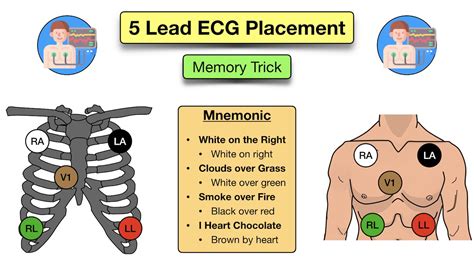 How To Place A 5 Lead Ecg Acronym Mnemonic Diagram For Electrode