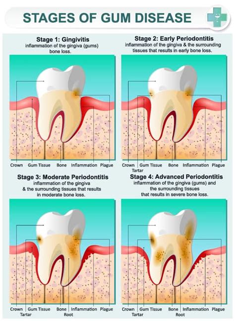 How To Get Rid Of Gingivitis Treatment For Bleeding Gum Disease Diet