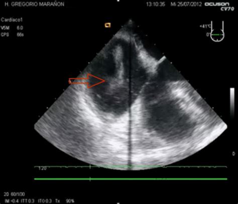 Echocardiography Findings In A Massive Pulmonary Embolism Pe With Download Scientific