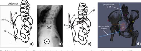 Pdf Asis Anterior Superior Iliac Spine Psis Posterior Superior