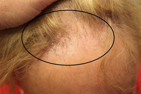 Frontal Fibrosing Alopecia Causes Symptoms Diagnosis Treatment Prognosis