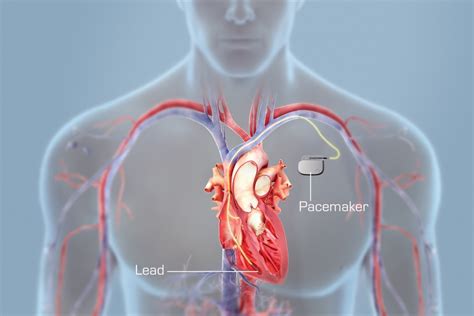 All You Need To Know About Living With A Pacemaker Fitneass