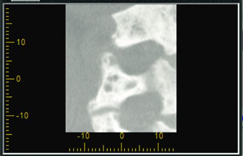 Multiple Lytic Lesions On Vertebrae Are Shown In The Crosssectional